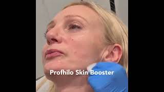 Profhilo injectable moisturiser demo at City Skin Clinic shortsvideo beauty skincare profhilo [upl. by Elisee]