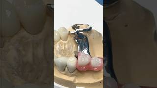 Amazing Partial Bridge and Crown Combo Case lsk121shorts dentist dentistteeth [upl. by Aniteb]