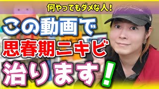 【ニキビ対策スキンケア】思春期ニキビをケアする方法！男子も女子も改善しちゃおう！ [upl. by Eibbob]