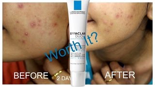 La Roche Posay Effaclar Duo Review  Worth it [upl. by Eillek]