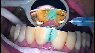 Cosmetic and functional bonding technique  Teeth numbers 8 and 9  Dr Gerard Cuomo [upl. by Ric5]