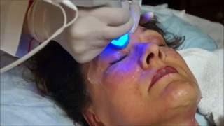 BTL Exilis Ultra  Dr Shel Wellness amp Aesthetic Center [upl. by Aihseym]