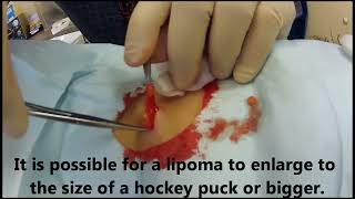 Office Procedure Lipoma Removal [upl. by Nnawaj]