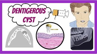 ORAL PATHOLOGY  DENTIGEROUS CYST [upl. by Nickerson]