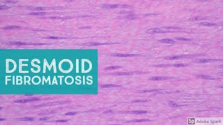 Desmoid Fibromatosis Desmoid Tumor  Explained by a Soft Tissue Pathologist [upl. by Heilner]