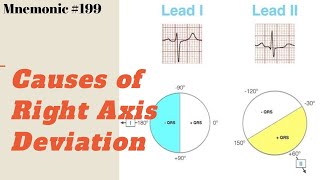 Causes of Right Axis Deviation ECG Mnemonic [upl. by Yelekalb]