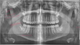 Interprétation de la panoramique dentaire [upl. by Norm]