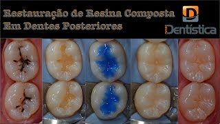 Restauração de resina composta em dente posterior [upl. by Ahseekan]