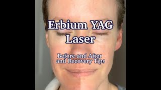 YAG Laser Eye Treatment with Dr Michael Richie [upl. by Llehsar722]