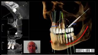 Zygomatic Immediate Load Dental Implant Planning [upl. by Doig]