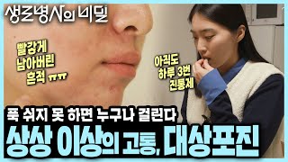 유달리 피곤하고 힘들던 때에 대상포진에 걸린 사람들 I 대상포진 골든타임을 잡아라 I KBS 250212 방송 [upl. by Eseela]