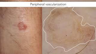 Dermoscopic features of porokeratosis  Dr John Paoli [upl. by Egiaf]