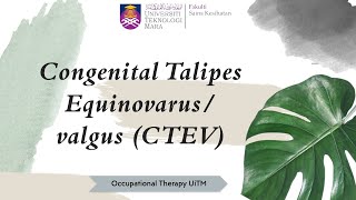 LESSON 8 CONGENITAL TALIPES EQUINOVARUSVALGUS CTEV [upl. by Holmen]