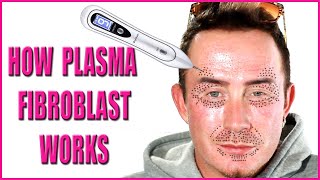 Plasma Fibroblast  How Fibroblast Plasma Works Beneath the Skin [upl. by Warrick]