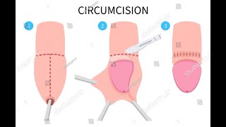 Circumcision Surgery  Step by Step Procedure  Circumcision Animation [upl. by Zetnod]