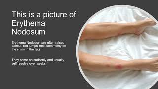 Erythema Nodosum  Brief Review and Photo [upl. by Peery]