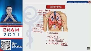 TRAUMA TORACICO EN CIRUGÍA DE TÓRAX Y CARDIOVASCULAR  Hemotórax Masivo [upl. by Ahsinyar140]