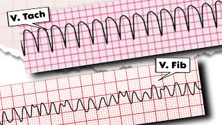 Ventricular Tachycardia vs Ventricular Fibrillation Key Differences Explained [upl. by Allys152]