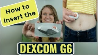 Dexcom G6 Sensor Insertion Tutorial Continuous Glucose Monitor [upl. by Enasus]