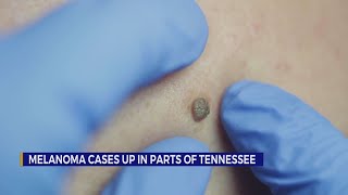 Melanoma cases up in parts of Tennessee [upl. by Kress648]