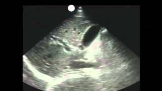 How To Gallbladder Ultrasound Part 1  Introduction Case Study Video [upl. by Stucker]