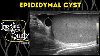 Epididymal Cyst  Ultrasound  Case 51 [upl. by Dearborn]