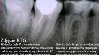 Na czym polega leczenie endodontyczne kanałowe zęba [upl. by Annaoi890]