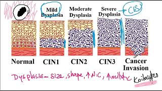 USMLE ACE Video 88 Human Papillomavirus HPV and Cervical Cancer Risk Factors [upl. by Enyawud]