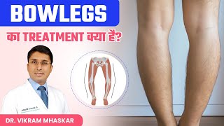 Bow Legs का Treatment क्या है  Bow Legs को कैसे ठीक किया जाता है  Dr Vikram Mhaskar [upl. by Nowyt]