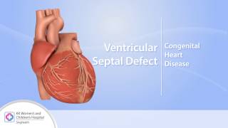 Heart Conditions – Ventricular Septal Defect VSD [upl. by Kaine]