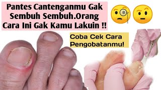 MENGATASI CANTENGAN KAKI 👣 [upl. by Otreblaug]