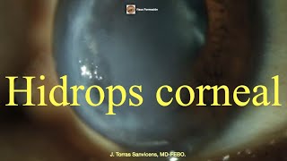 Hidrops Corneal [upl. by Ettesus]