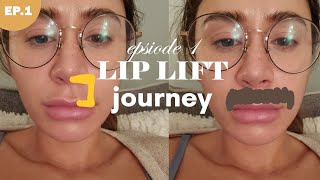 LIP LIFT SURGERY 💉 Episode 1  why I am getting a lip lift [upl. by Etteoj668]