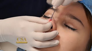 The semipermanent effect of nose threadlift [upl. by Aytac]