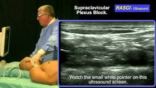 Ultrasound guided Supraclavicular plexus block [upl. by Cogen]