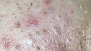 Nasa SPA 2021  Satisfying blackhead Acne Relaxing [upl. by Bascio]