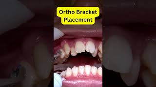 Braces Installation REVEALED Step by Step [upl. by Arot]