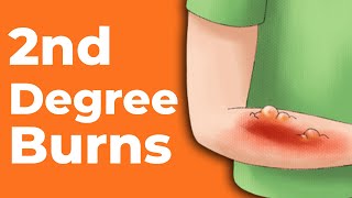 How to Treat Burn at Home  Types of Burns [upl. by Sackey]