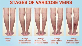 Stages of Varicose Veins [upl. by Enelia847]