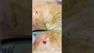 Erosive Pustulosis of the Scalp  Pimple Popping shorts [upl. by Keithley]