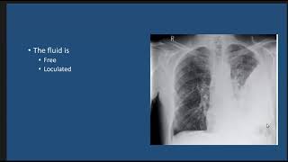 Thoracic Empyema case discussion [upl. by Niltac731]