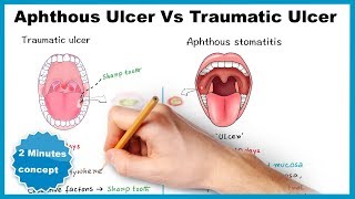 Aphthous ulcerstomatitis Vs Traumatic ulcer [upl. by Nived]