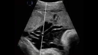 How to Obtain and Measure the Umbilical Artery Doppler Waveform [upl. by Leahicm]