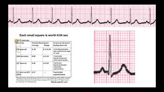 How to Determine Intervals amp Segments on EKG EXPLAINED [upl. by Braswell50]