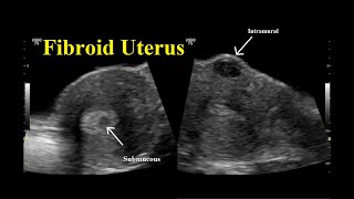 Fibroid Uterus  Ultrasound  Case 01 [upl. by Mann]