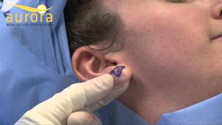 Stretched earlobe repair  Aurora Clinics [upl. by Weide]