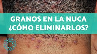 GRANOS EN LA NUCA  Causas y remedios para ELIMINARLOS 🤚🏼 [upl. by Ellicec858]