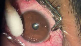 StepbyStep Corneal Collagen Crosslinking Sub400 Protocol for Thin Corneas [upl. by Hsejar]