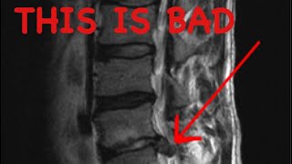 How to Read a Spine MRI [upl. by Ebonee893]