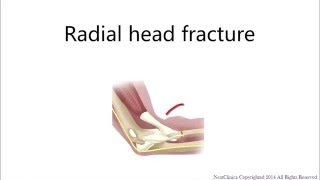 Radial head fracture [upl. by Ayota607]